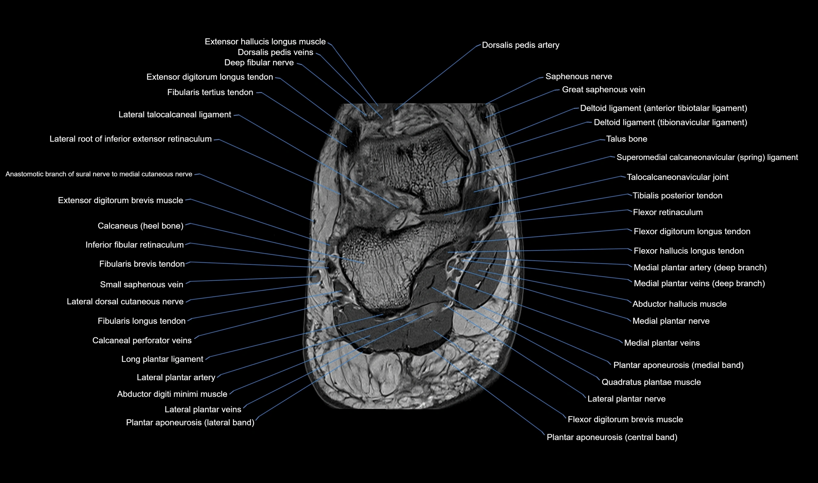 MRI mid foot axial cross sectional anatomy 3T  radiology  image-img-00001-00043.webp